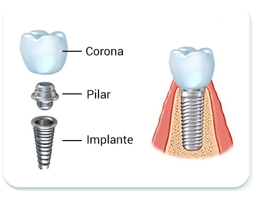 iomty-implante-dental