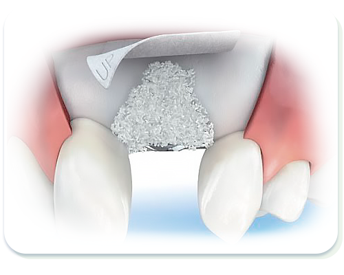 iomty-preservacion-alveolar